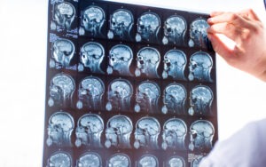 What Is a Traumatic Brain Injury?